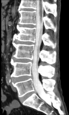 CT Myelographie mit gleichzeitiger, hochauflösender Darstellung des knöchernen und häutigen Wirbelkanals (Spinalkanals).