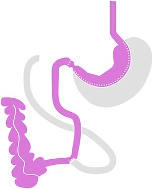 Biliopankreatische Diversion mit Duodenal-Switch