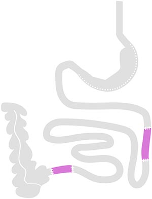 Ileum-Transposition nach Paula