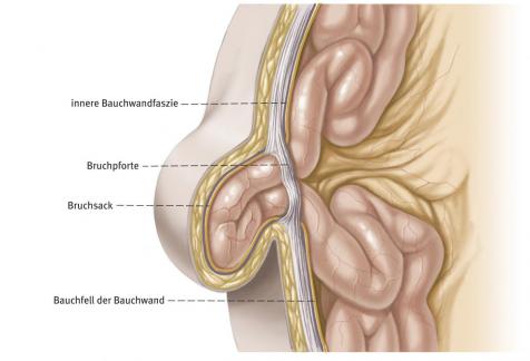 Aufbau einer Hernie