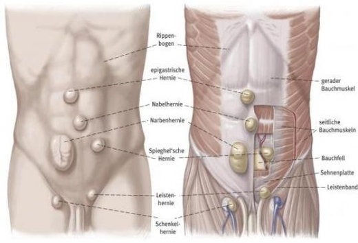 Übergewicht bauchdeckenbruch Patienten mit