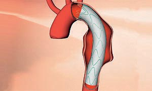 Thorakaler Stentgraft E-vita thoracic 