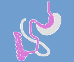 Biliopankreatische Diversion mit Duodenal-Switch