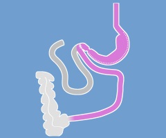 Single anastomosis duodeno-Ileal bypass