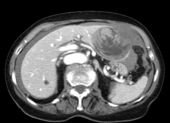 Computertomographie eines blutenden Leberadenoms