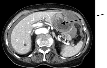 Computertomographie eines blutenden Leberadenoms