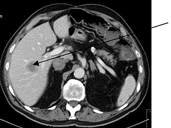 Lebermetastase in der Computertomographie