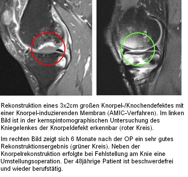 Arthrose des Kniegelenkes: Gelenkerhaltende Therapie