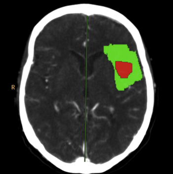 CT-Perfusionsuntersuchung