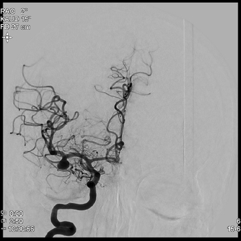 Darstellung eines Aneurysma der mittleren Hirnarterie rechts.