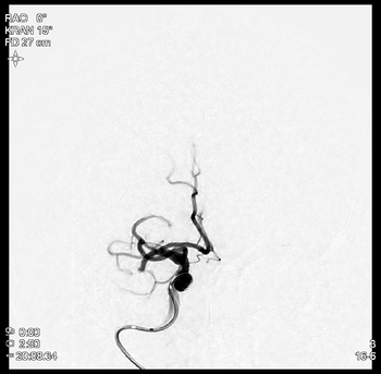 Darstellung eines embolischen Verschlusses der mittleren Hirnarterie rechts. Ein Aspirationskatheter und Mikrokatheter sind bereits bis in den Schädel vorgeführt.