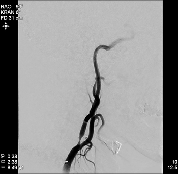 Darstellung einer höhergradigen Verengung einer Halsschlagader rechts.
