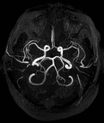 MRA der Hirnarterien ohne Einsatz eines Kontrastmittels.
