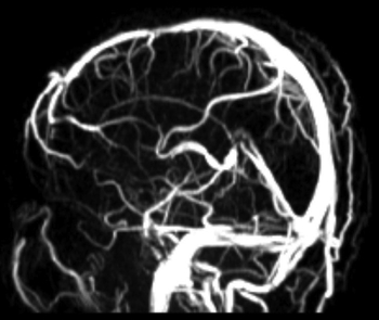 MRA der Hirnvenen ohne Einsatz eines Kontrastmittels.