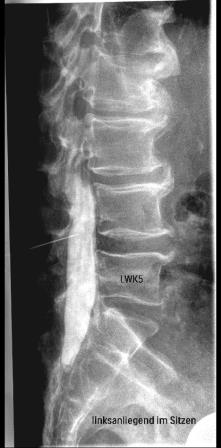 Röntgenbild mit Darstellung des mit Kontrastmittel gefüllten Spinalkanals und der Punktionskanüle zwischen dem vierten und fünften Lendenwirbel.