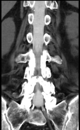 CT Myelographie mit gleichzeitiger, hochauflösender Darstellung des knöchernen und häutigen Wirbelkanals (Spinalkanals).