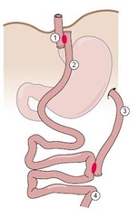 Roux Y Magenbypass