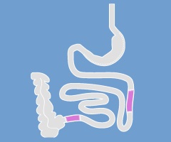  Ileum-Transposition nach Paula