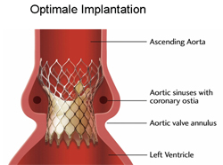 Implantierte Klappe in Aortenposition