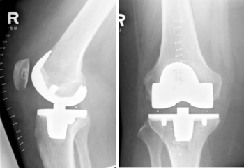 Beispiel einer Totalendoprothese des Kniegelenkes