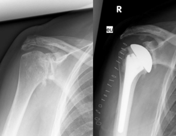 Fortgeschrittene Arthrose