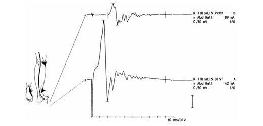 Typische motorische Neurographie des N. tibialis beim GBS (AIDP)