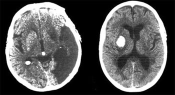 CT einer Hirnblutung und einer Mangeldurchblutung im späteren Stadium