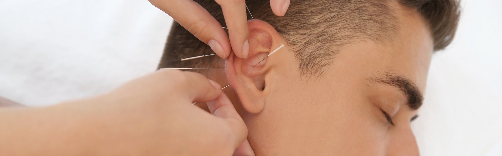 Akupunktur