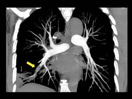 Computertomographie der Lungengefäße