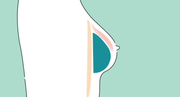 Lage des Implantats hinter dem Muskel