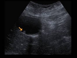 Ultraschall des Bauches