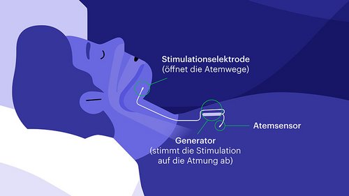 Schematische Skizzen-Zeichnung, die beschreibt, wie ein Zungenschrittmacher funktioniert.