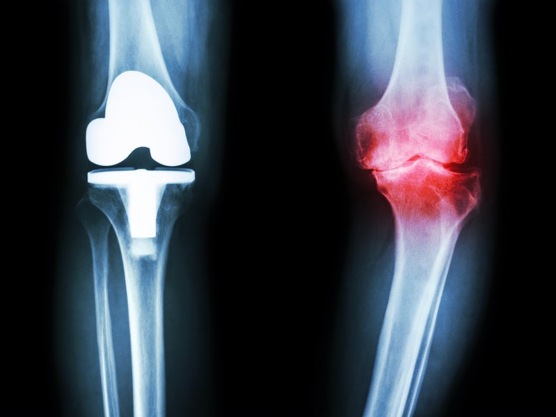 „Behandlungsmöglichkeiten bei Arthrose im Knie von AZ“ ArztPatientenAbend in den Sana „Behandlungsmöglichkeiten bei Arthrose im Knie von AZ“ ArztPatientenAbend in den Sana