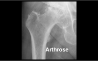 Arthrose