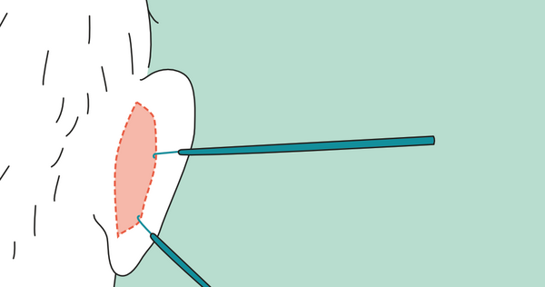 Schnittführung auf der Ohrrückseite