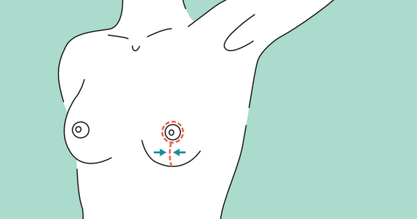 Schnittführung Brustverkleinerung