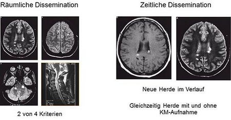 Abbildung 4: MRT bei MS