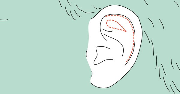 Neu geformte Furche der Ohrmuschel