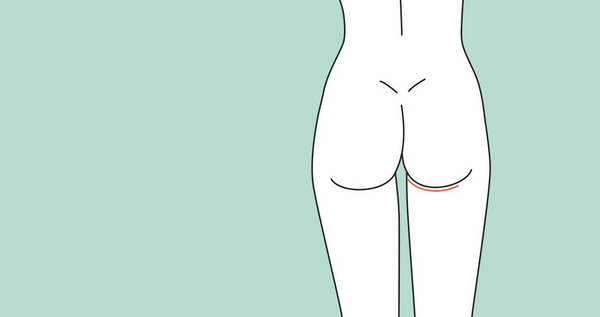 Narbenbild nach TMG/PAP