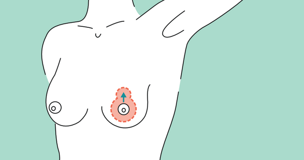 Versetzung der Brustwarze