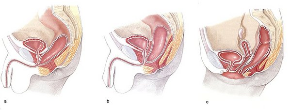 Analtresie