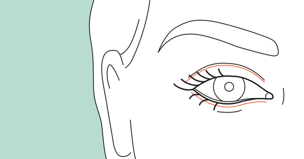 Narbenverlauf nach Lidstraffung