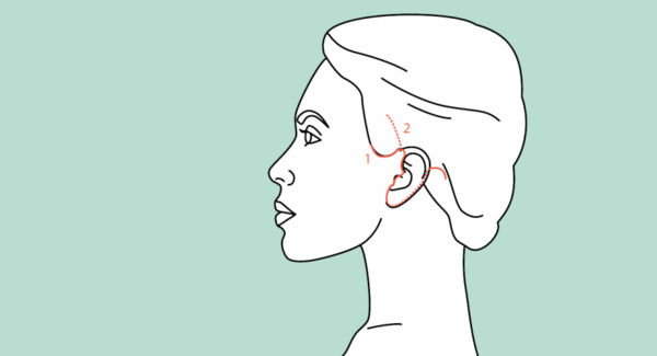 Facelift: Narbenverlauf