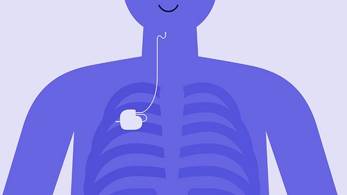 Schematische Skizzen-Zeichnung, die zeigt, an welcher Stelle  im Körper ein Zungenschrittmacher nach der Implantation liegt.
