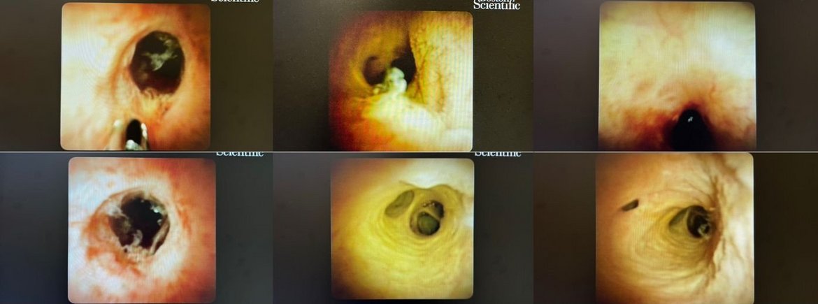 Sana Newsletter Benrath 2026- Bilder aus dem Gallengang und der Gallenwegen in der Leber