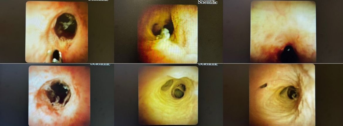 Sana Newsletter Benrath 2026- Bilder aus dem Gallengang und der Gallenwegen in der Leber