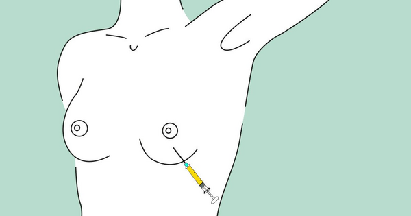 Brustrekonstruktion mit Eigenfett