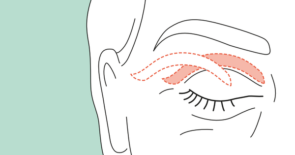 Entfernung der überschüssigen Haut Oberlid