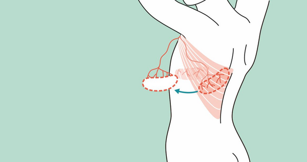 Hebung Latissimus dorsi Lappen