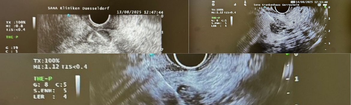 Sana Newsletter Benrath- endosonographische FNP von unklaren Raumfoderungen im Pankreas